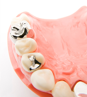 銀歯が気になる方へ